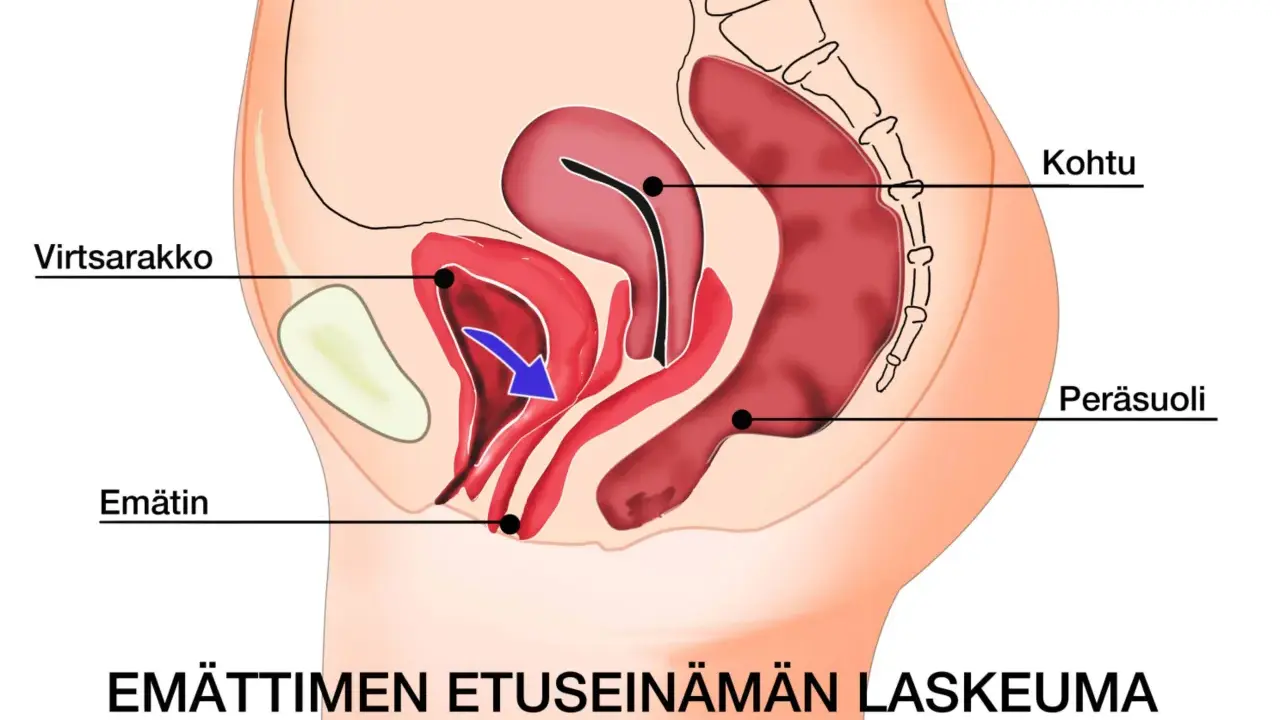 Illustration av bäckenorgan som visar en utbuktning i slidan, en cystocele, där urinblåsan buktar ner.