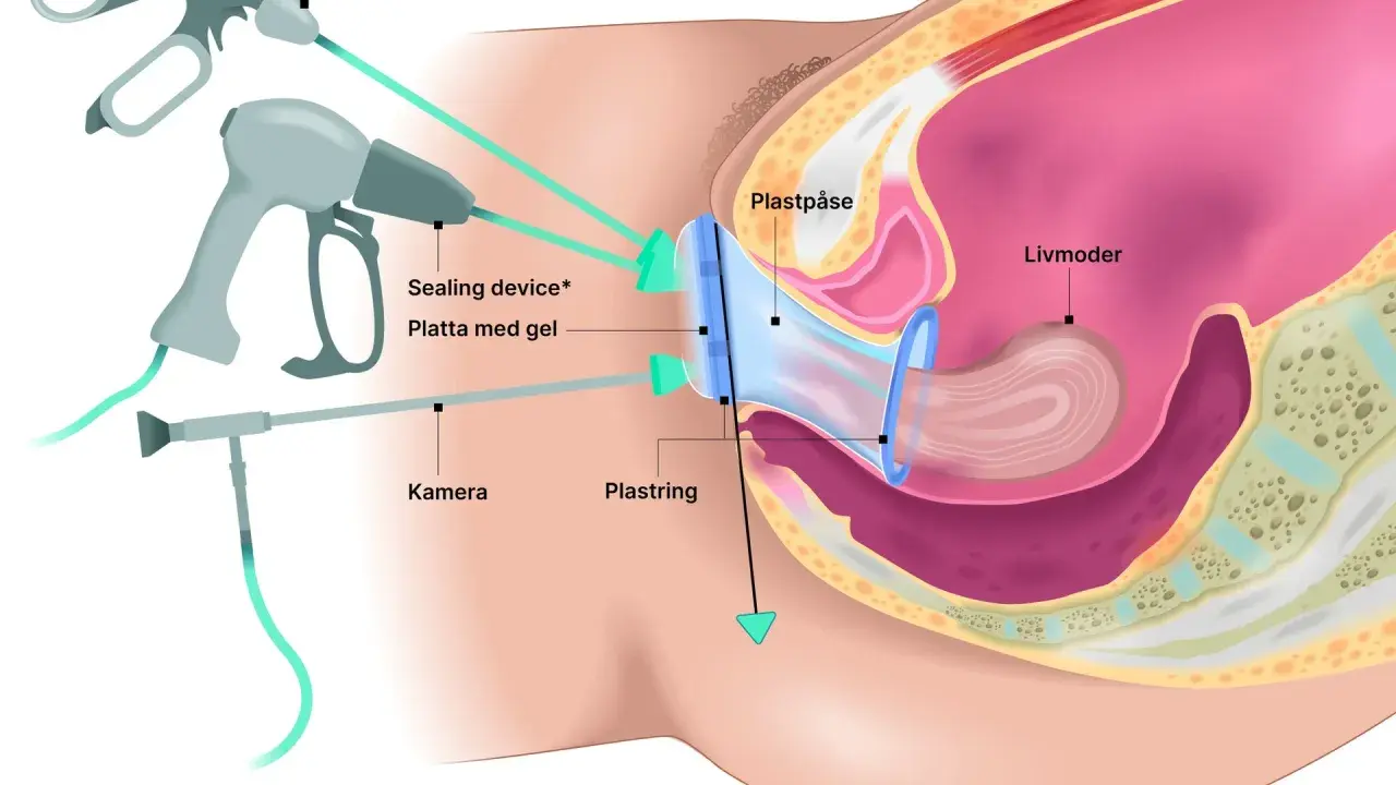 Illustration av en framfall operation med en plastpåse och ring som stödjer livmodern. Verktyg för kirurgi syns.