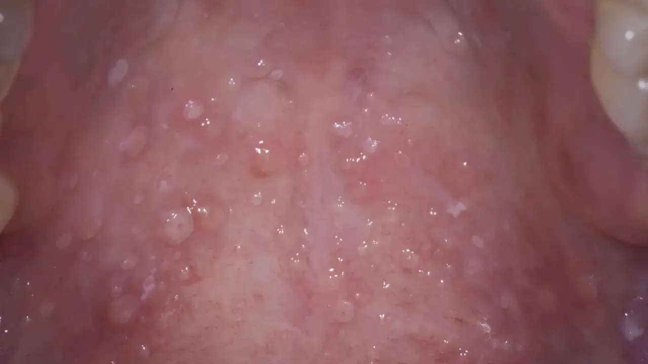 Närbild av gommen med många små blåsor, vilket kan vara tecken på herpes i gommen.