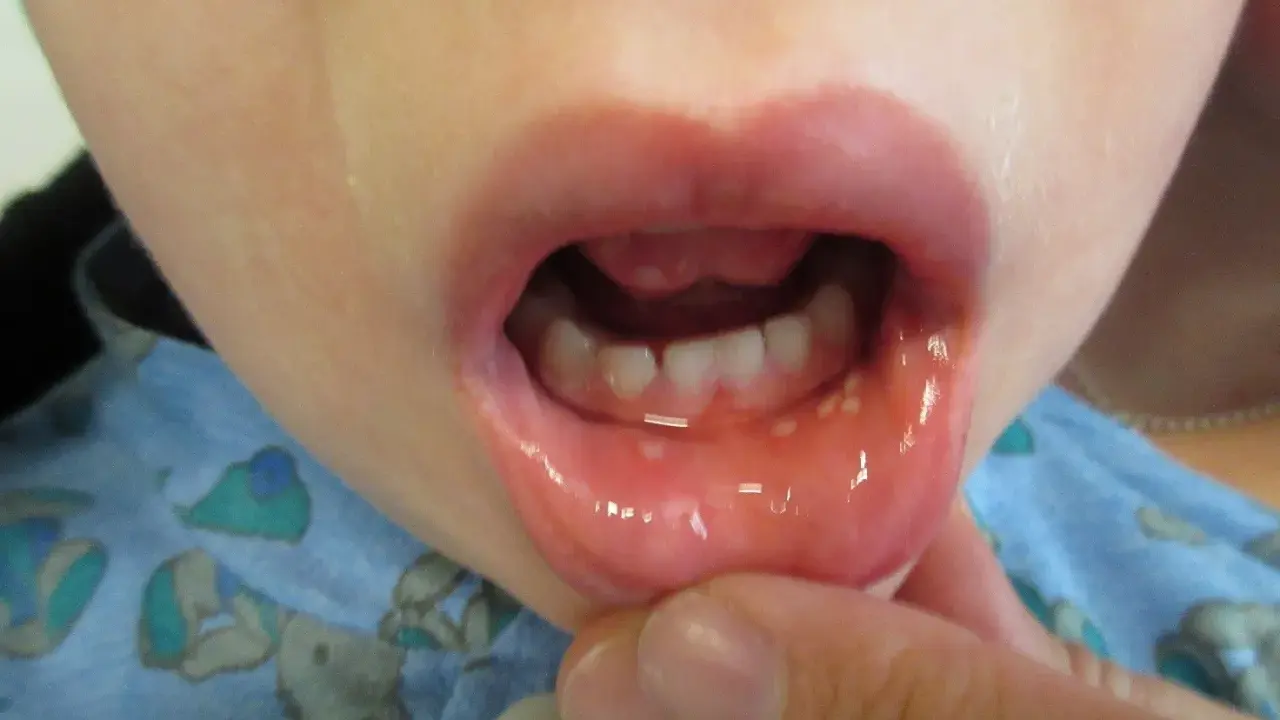 Barnets mun visar små blåsor och rodnad, tecken på herpetisk gingivostomatit.