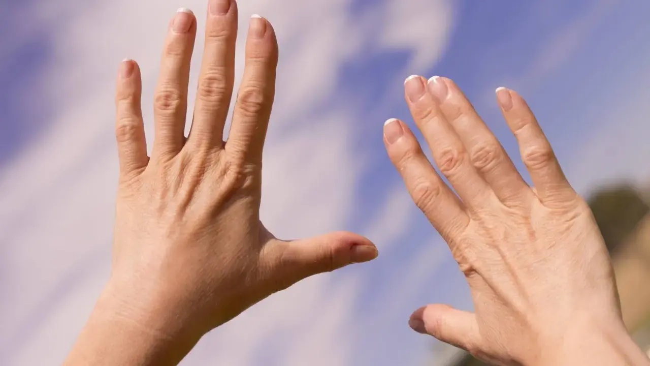Två händer med sneda fingrar, kanske ett tecken på reumatism, sträcks mot en blå himmel med moln.
