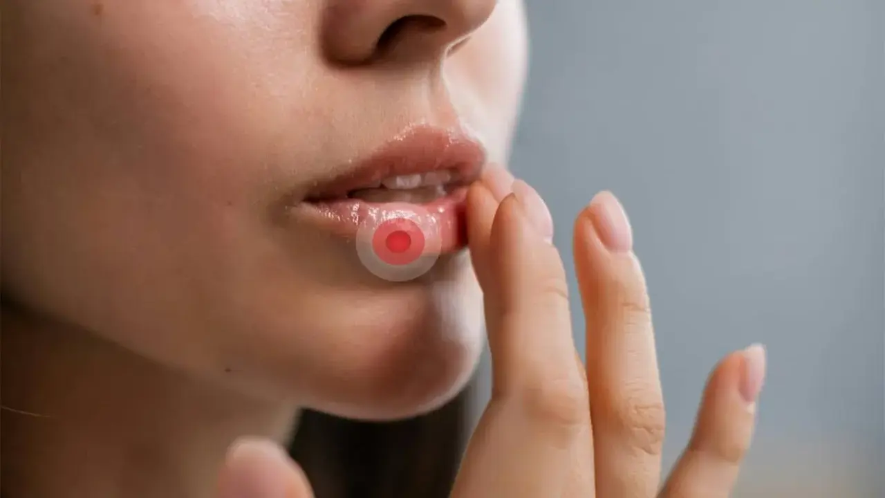 Närbild på läppar med ett plåster för herpes. En hand rör vid läppen.