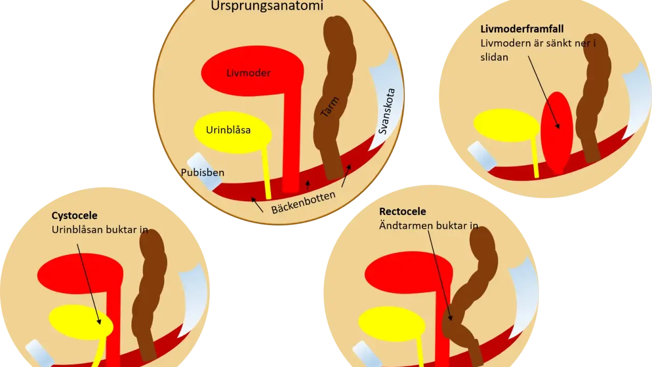 Illustrationer visar bäckenbottenproblem: livmoderframfall, cystocele och rektosele. Normal anatomi visas först.