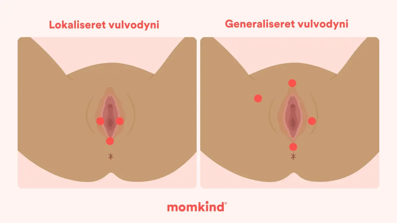 Illustrationer visar lokaliserad och generaliserad vulvodyni, med röda prickar som markerar smärtpunkter. Det kan kännas som ett tryck i underlivet.