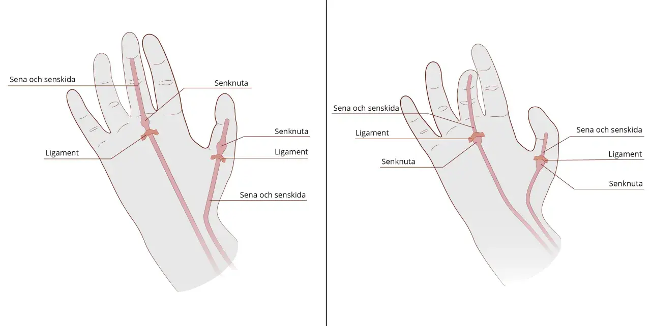 Illustrationer av handens senor, ligament och senknutor. En senknuta kan orsaka stela fingrar.