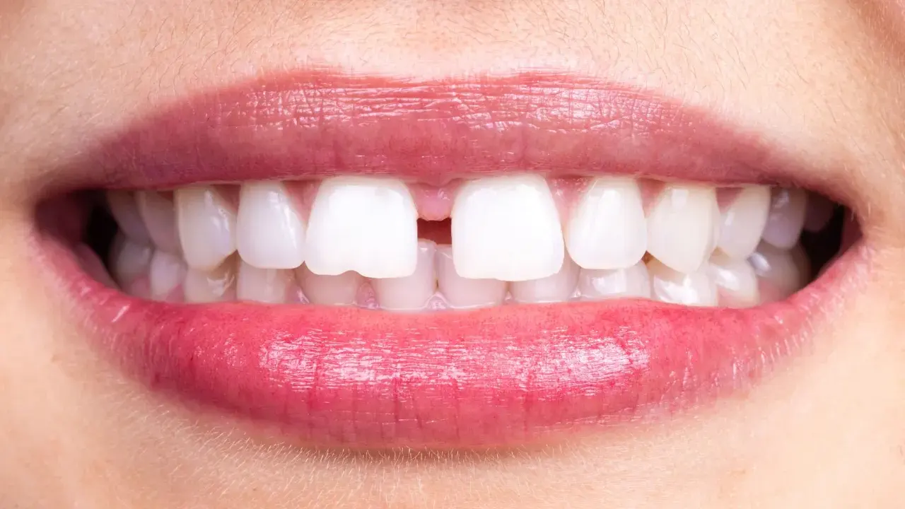 Närbild på en mun med ett tydligt diastema mediale mellan framtänderna. Läpparna är glansiga och rosa.