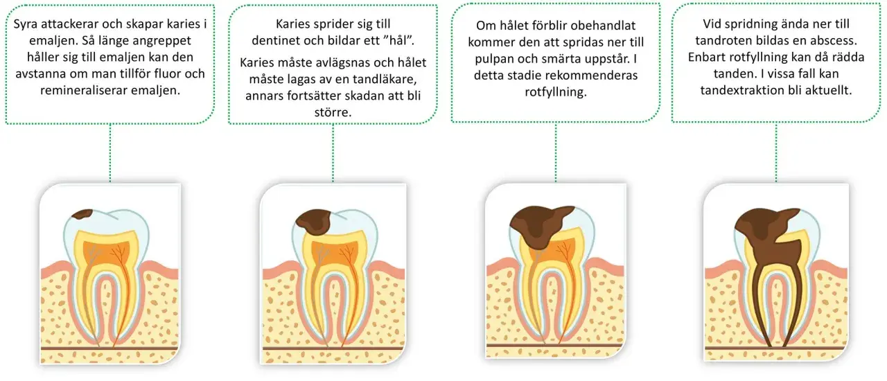 Bilden visar hur karies utvecklas i en tand, från emaljen till pulpan och roten. Om karies inte behandlas kan det leda till abscess och tandutdragning.