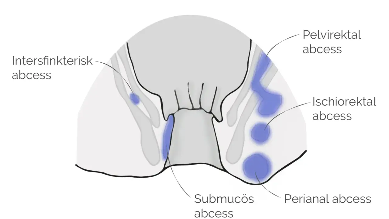 Illustration visar olika typer av abscesser i underlivet: perianal, ischiorektal, submukös, intersfinkterisk och pelvirektal.