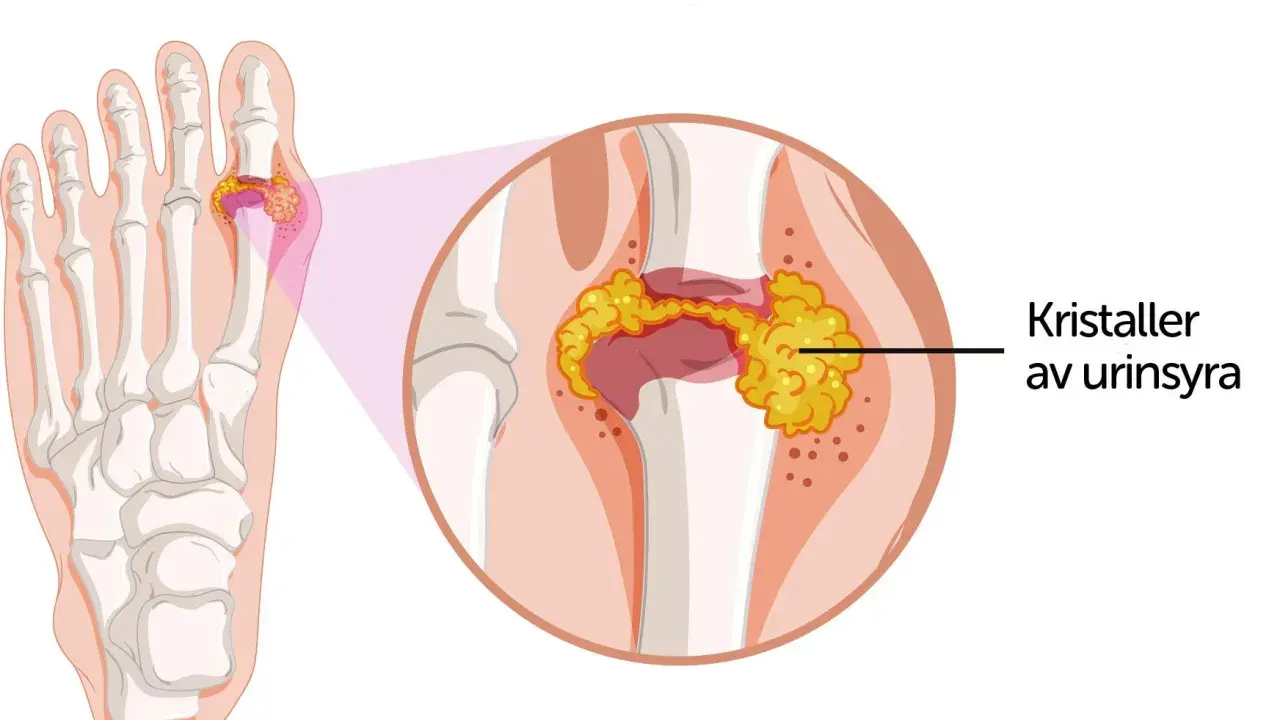 Illustration av en fotled med svullet gomsegel, där urinsyrakristaller samlats i leden.
