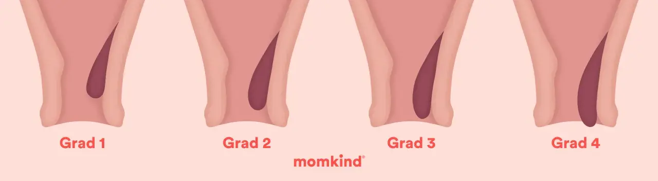 Illustrationer visar grader av anteflekterad uterus, från grad 1 till 4, med en mörkare nyans som representerar livmodern.