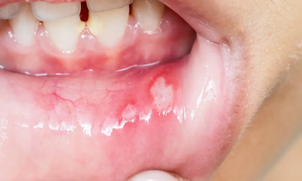 Munnen visar sår som kan vara afte eller herpes. De är röda och inflammerade.