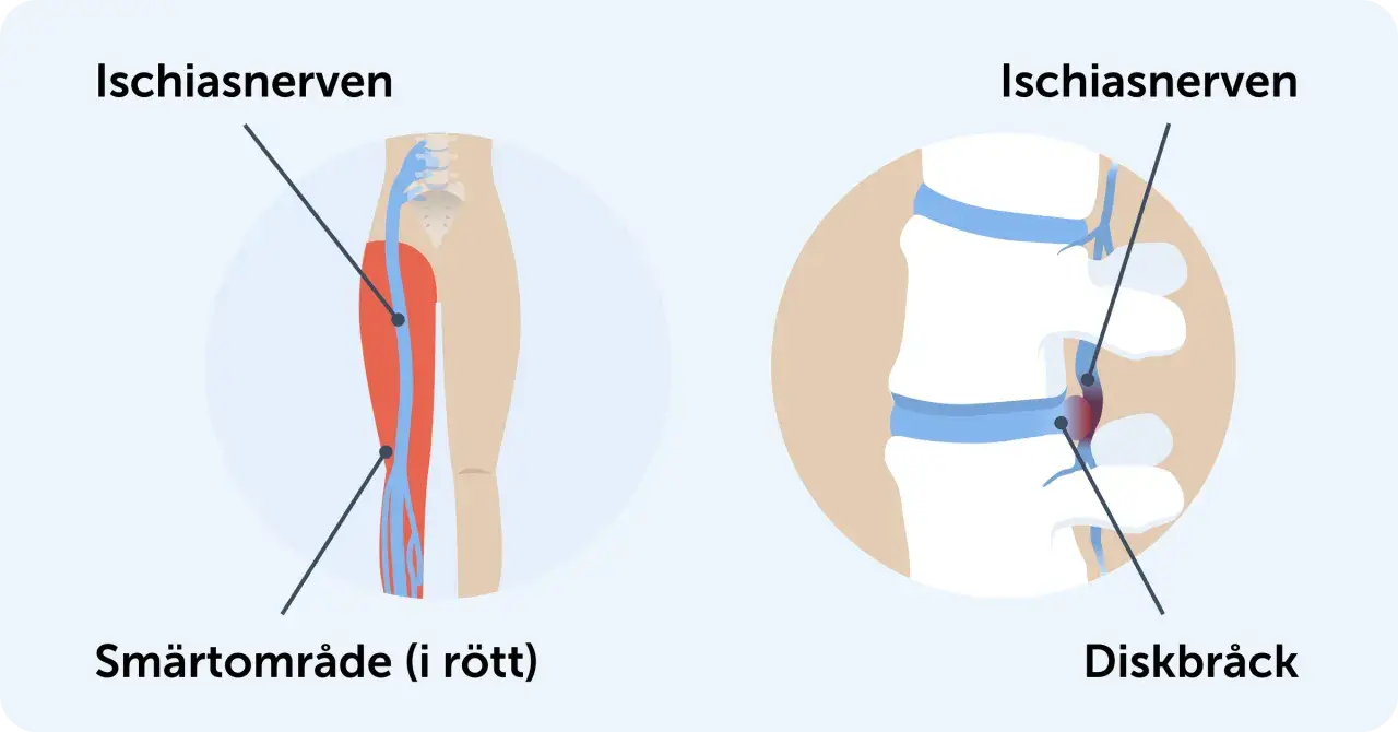 Illustration visar iskiasnerven och smärtområde i benet, samt diskbråck som orsakar akut ischias.