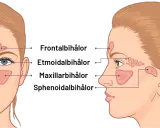Illustration av bihålorna i ansiktet. Kan visa hur tandproblem kan leda till dental sinuit.