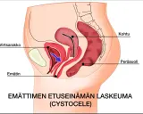 Illustration av bäckenorgan som visar en utbuktning i slidan, en cystocele, där urinblåsan buktar ner.