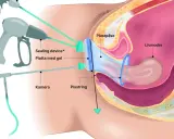 Illustration av en framfall operation med en plastpåse och ring som stödjer livmodern. Verktyg för kirurgi syns.