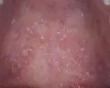Närbild av gommen med många små blåsor, vilket kan vara tecken på herpes i gommen.