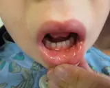 Barnets mun visar små blåsor och rodnad, tecken på herpetisk gingivostomatit.