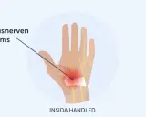 Illustration av handleden där medianusnerven kläms, vilket orsakar karpaltunnelsyndrom och ont i tummen.
