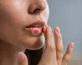 Närbild på läppar med ett plåster för herpes. En hand rör vid läppen.