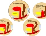 Illustrationer visar bäckenbottenproblem: livmoderframfall, cystocele och rektosele. Normal anatomi visas först.