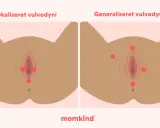 Illustrationer visar lokaliserad och generaliserad vulvodyni, med röda prickar som markerar smärtpunkter. Det kan kännas som ett tryck i underlivet.