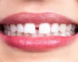 Närbild på en mun med ett tydligt diastema mediale mellan framtänderna. Läpparna är glansiga och rosa.