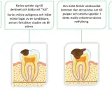 Bilden visar hur karies utvecklas i en tand, från emaljen till pulpan och roten. Om karies inte behandlas kan det leda till abscess och tandutdragning.