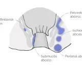 Illustration visar olika typer av abscesser i underlivet: perianal, ischiorektal, submukös, intersfinkterisk och pelvirektal.