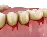 Tänder med synliga gingivit symtom. Tandköttet blöder runt tänderna, vilket indikerar inflammation.