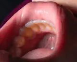 Närbild av en munhåla med tänder och en liten cysta i munnen.