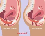 Illustration visar bäckenbotten i avslappnat och kontraherat läge. Träning kan hjälpa mot foglossning blygdbenet.