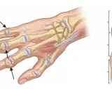 Illustration av handens skelett med tydliga bouchards knutor vid fingerlederna.