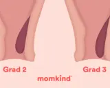 Illustrationer visar grader av anteflekterad uterus, från grad 1 till 4, med en mörkare nyans som representerar livmodern.