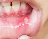 Munnen visar sår som kan vara afte eller herpes. De är röda och inflammerade.