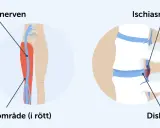 Illustration visar iskiasnerven och smärtområde i benet, samt diskbråck som orsakar akut ischias.