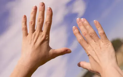Två händer med sneda fingrar, kanske ett tecken på reumatism, sträcks mot en blå himmel med moln.