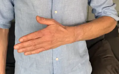 Man visar sin hand, tummen är böjd. Kan vara relaterat till senskideinflammation tumme.
