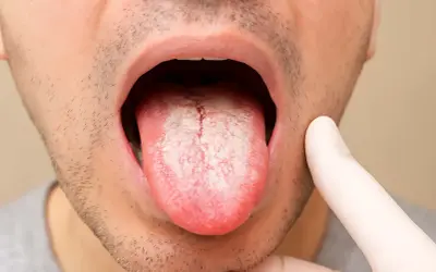 En person visar upp en belagd tunga, en vanlig åkomma där huskur kan lindra sveda på tungan.