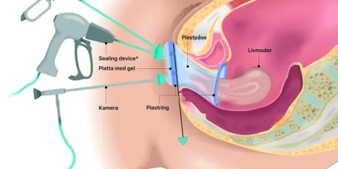 Illustration av en framfall operation med en plastpåse och ring som stödjer livmodern. Verktyg för kirurgi syns.