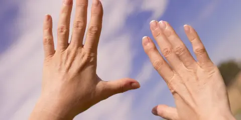 Två händer med sneda fingrar, kanske ett tecken på reumatism, sträcks mot en blå himmel med moln.
