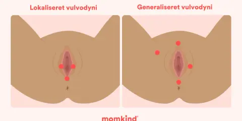 Illustrationer visar lokaliserad och generaliserad vulvodyni, med röda prickar som markerar smärtpunkter. Det kan kännas som ett tryck i underlivet.