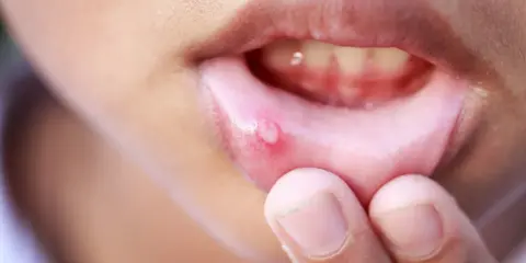 Närbild på en mun med en röd och vitblåsa i underläppen, som en liten blodblåsa i munnen.