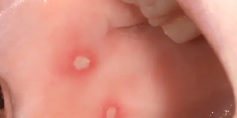 Munnen visar sår, troligen afte, som kan vara smärtsamma.