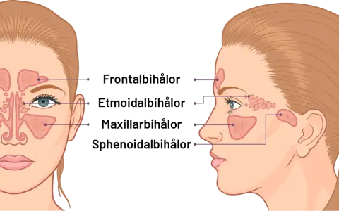 Illustration av bihålorna i ansiktet. Kan visa hur tandproblem kan leda till dental sinuit.