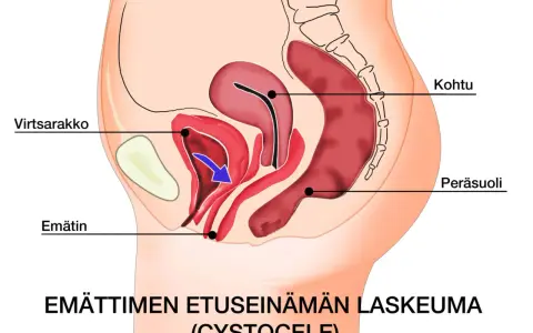 Illustration av bäckenorgan som visar en utbuktning i slidan, en cystocele, där urinblåsan buktar ner.