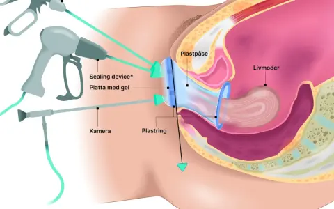 Illustration av en framfall operation med en plastpåse och ring som stödjer livmodern. Verktyg för kirurgi syns.