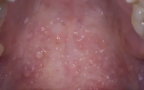 Närbild av gommen med många små blåsor, vilket kan vara tecken på herpes i gommen.