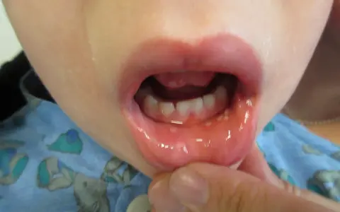 Barnets mun visar små blåsor och rodnad, tecken på herpetisk gingivostomatit.