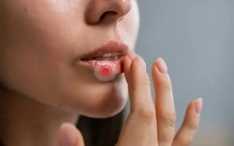 Närbild på läppar med ett plåster för herpes. En hand rör vid läppen.