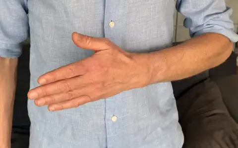 Man visar sin hand, tummen är böjd. Kan vara relaterat till senskideinflammation tumme.